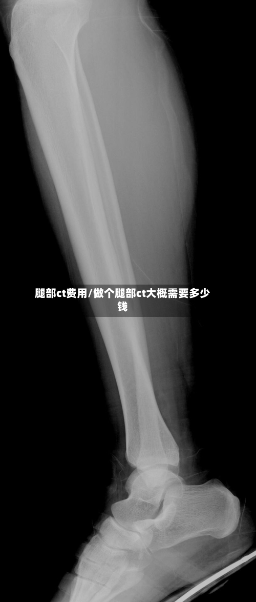 腿部ct费用/做个腿部ct大概需要多少钱