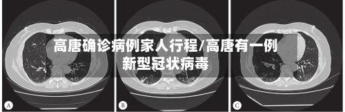 高唐确诊病例家人行程/高唐有一例新型冠状病毒