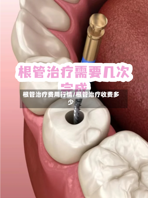 根管治疗费用行情/根管治疗收费多少-第2张图片