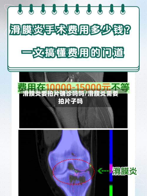 滑膜炎要拍片确诊吗吗/滑膜炎需要拍片子吗