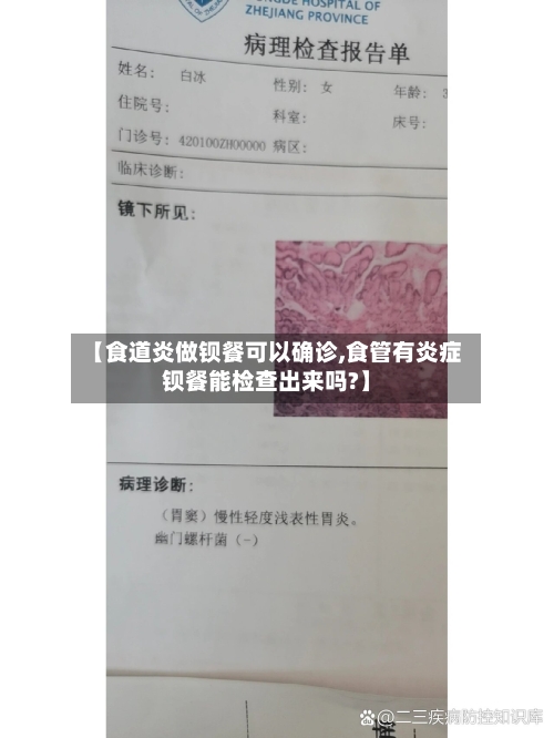 【食道炎做钡餐可以确诊,食管有炎症钡餐能检查出来吗?】-第3张图片