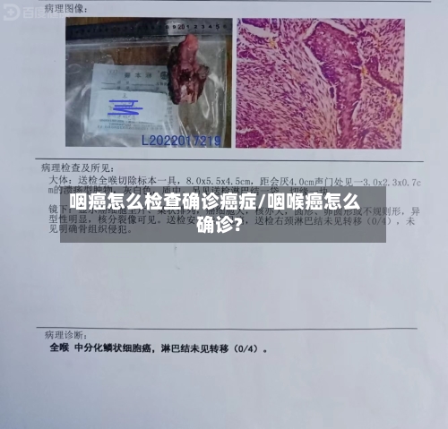 咽癌怎么检查确诊癌症/咽喉癌怎么确诊?-第2张图片